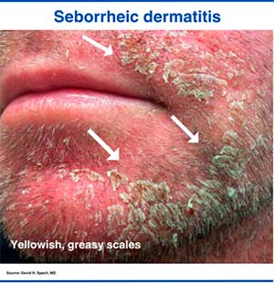 Seborrheic dermatitis on the face of an HIV-positive patient, manifested by marked yellowish scales.