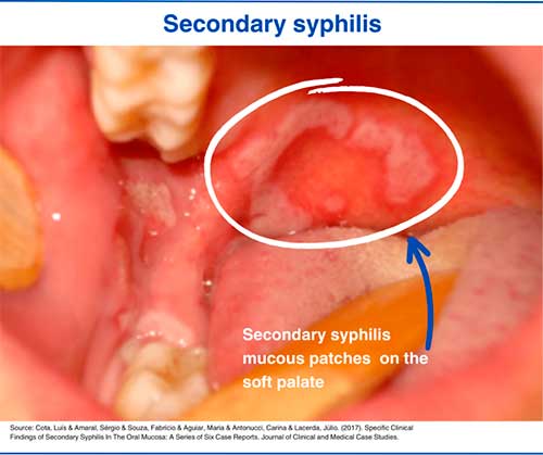Secondary syphilis