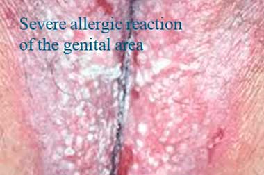 Severe allergic reaction of the genital area