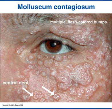 Severe form of Molluscum contagiosum rash on the face of an HIV-positive patient. The rash appears as flesh-colored, raised bump with a central dent