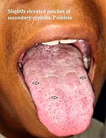 Slightly elevated patches of secondary syphilis. Painless