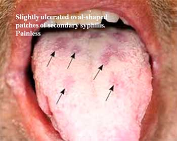 Slightly ulcerated oval-shaped patches of secondary syphilis. Painless