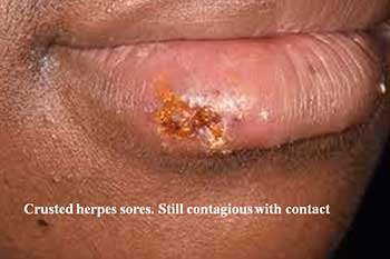 Crusted herpes sores. Still contagious with contact