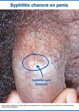 Syphilis rash on the penis