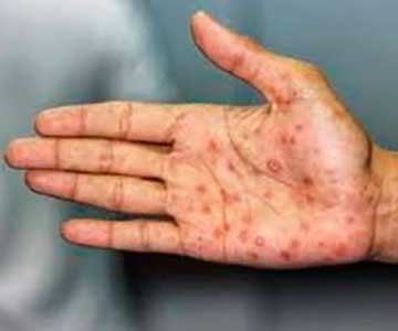 Syphilis symptoms pictures