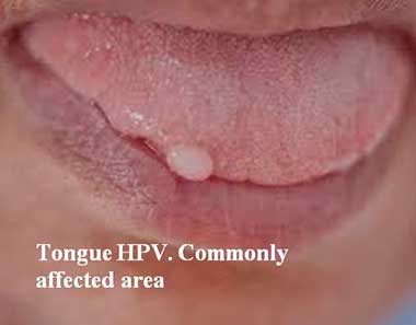 Tongue HPV. Commonly affected area