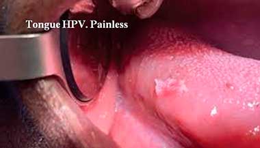 Tongue HPV. Painless