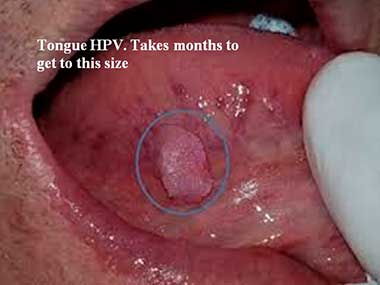 Tongue HPV. Takes months to get to this size