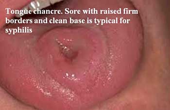 Tongue chancre. Sore with raised firm borders and clean base is typical for syphilis