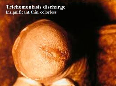 Trichomoniasis discharge. Insignificant, thin, colorless.