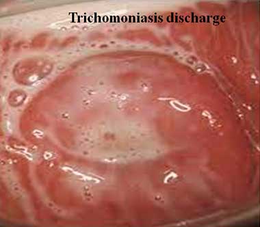 Trichomoniasis discharge