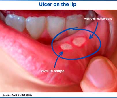 Ulcer on the lip