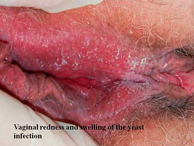 Vaginal redness and swelling of the yeast infection