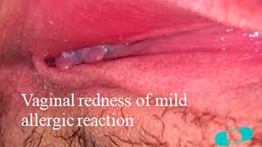 Vaginal redness of mild allergic reaction