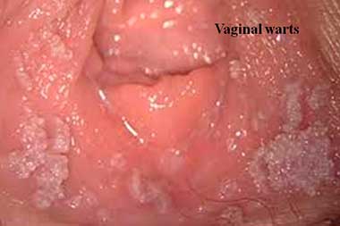 Vaginal warts