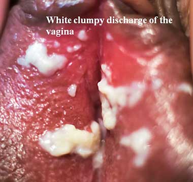 White clumpy discharge of the vagina