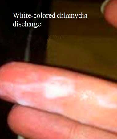 White-colored chlamydia discharge