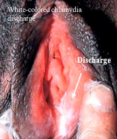 White-colored chlamydia discharge