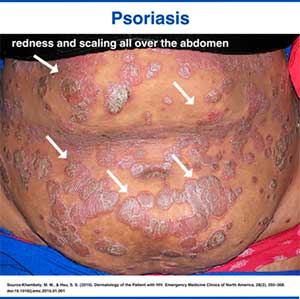 Widespread scaly psoriatic patches and redness in HIV-positive patient