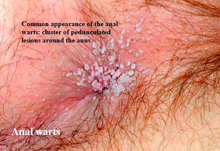 genital warts on testicles