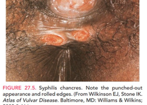two syphilis sores near the anus