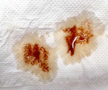 Brown vaginal discharge