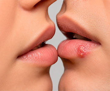 Can You Get Herpes From Kissing?
