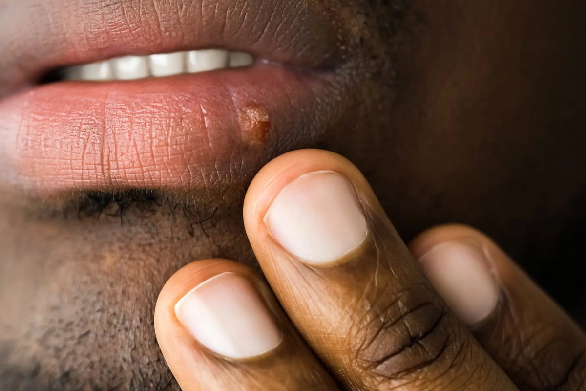 Small cold sore on the lower lip, darker skin