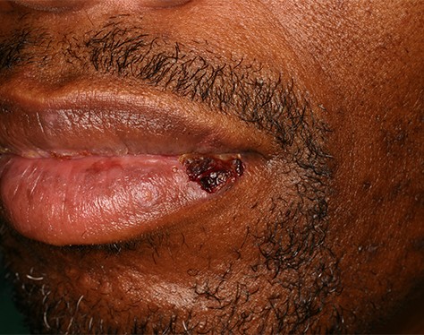 Crusted cold sore on the lower lip, darker skin