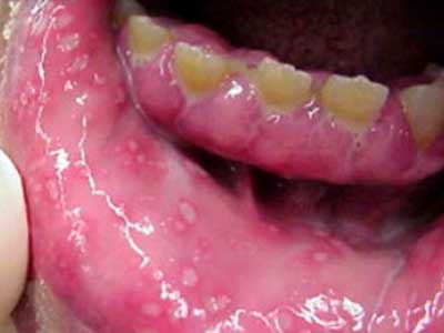 chlamydia mouth sores