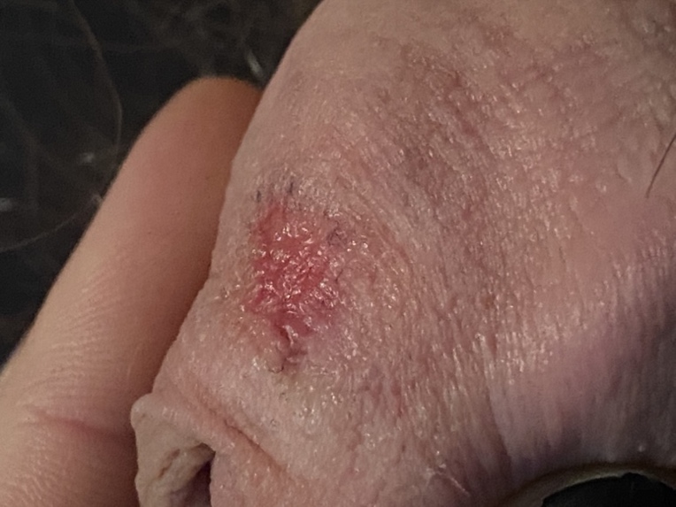 Friction burn from sex