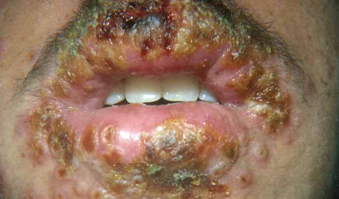 First herpes outbreak with many crusted sores around the mouth