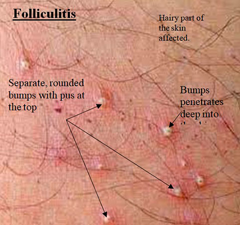 Herpetic Folliculitis Herpetic Folliculitis