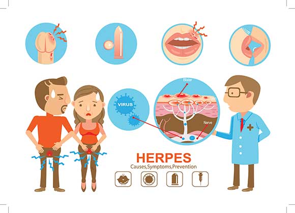Symptoms of Genital Herpes