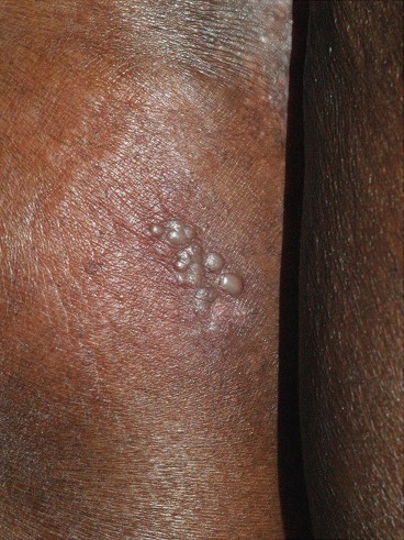 A cluster of herpes blisters on darker skin