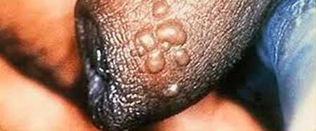 A cluster of herpes blisters on the foreskin