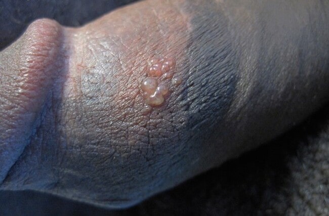 Genital herpes men pictures: a cluster of herpes blisters on the shaft of the penis