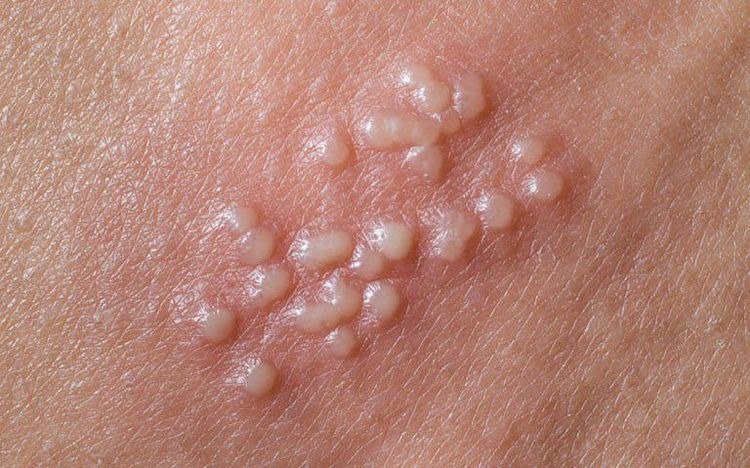 A herpes cluster: small blisters grouped on one red patch of skin