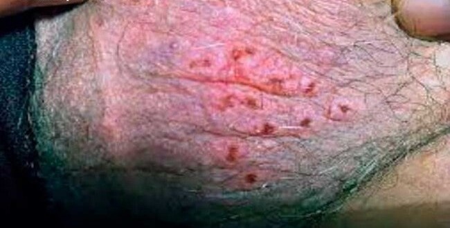 Crusted herpes sores on the scrotum