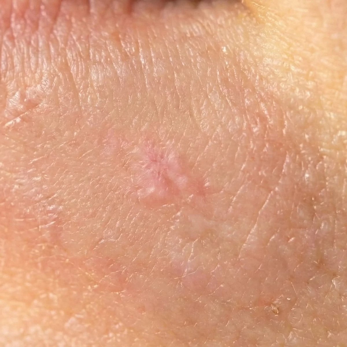 Healed skin after a herpes outbreak
