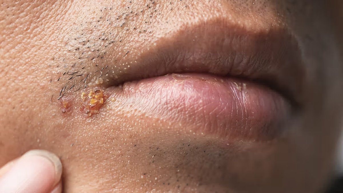 Crusting herpes sore at the corner of the mouth on brown skin
