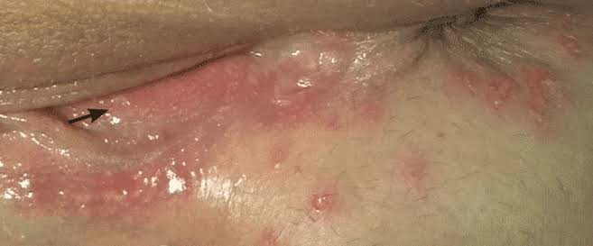 Healing herpes sores on the vulva