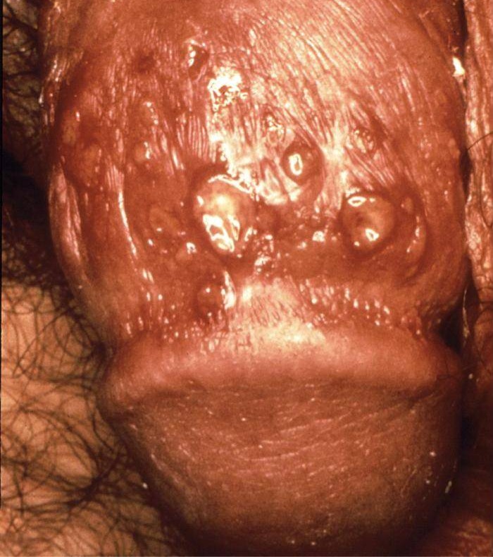 Herpes on the penis: blisters and open sores on the shaft, just behind the head