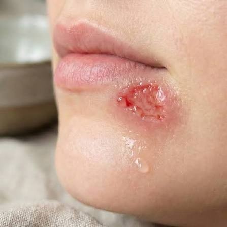 Open, oozing herpes sore below the lip