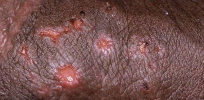 Open herpes sores on darker skin
