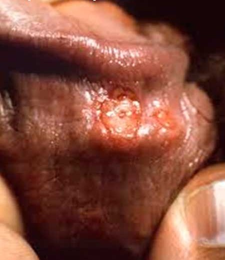 A herpes sore on the head of the penis