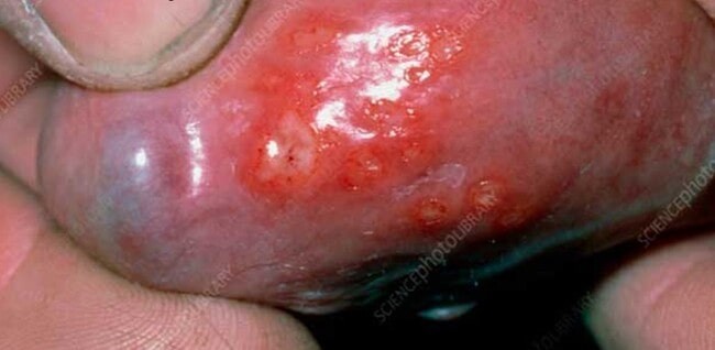 A herpes sore under the head of the penis