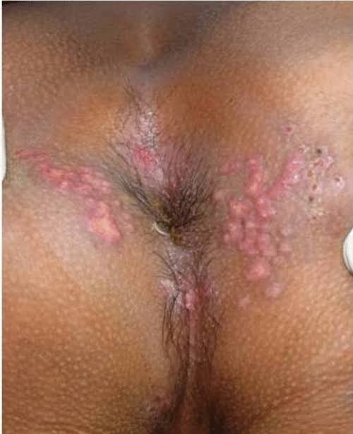 Herpes blisters and sores around the anus, darker skin