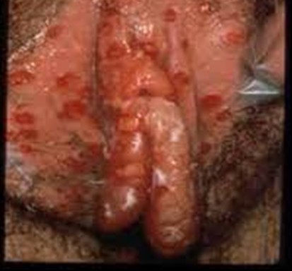 Herpes pictures female: sores on the labia majora and vulva