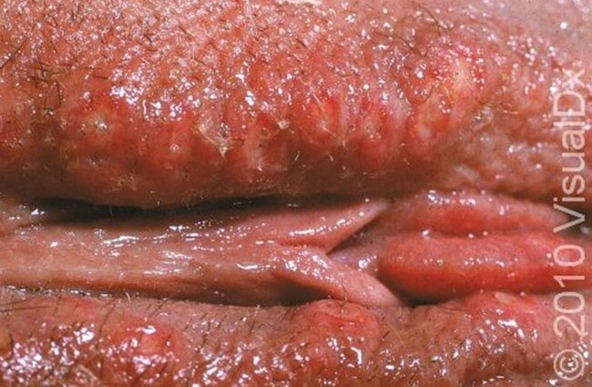 Herpes sores on the labia majora